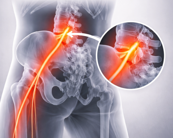 Sciatica and Nerve Pain at om Ayurveda