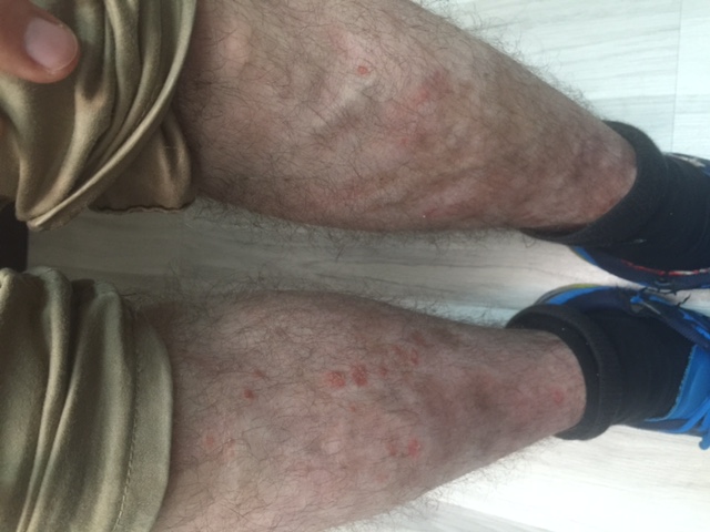 Psoriasis after therapy